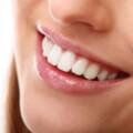 Tipos de Blanqueamiento Dental