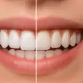 Diferencias entre Carillas de Cerámica y de Composite