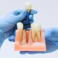 Implantes dentales en Mojácar